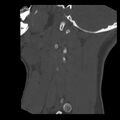 Clay-shoveler fracture (Radiopaedia 22568-22590 Sagittal bone window 2).jpg