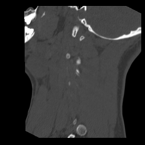 File:Clay-shoveler fracture (Radiopaedia 22568-22590 Sagittal bone window 2).jpg