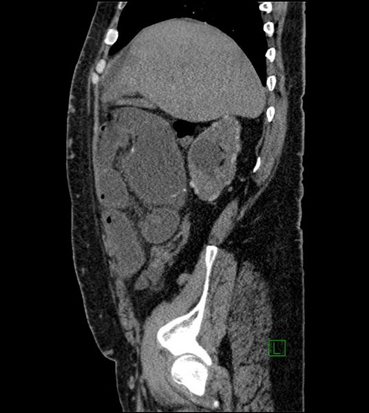 File:Closed-loop small bowel obstruction-internal hernia (Radiopaedia 78439-91096 C 108).jpg