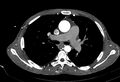 Coarctation of aorta with aortic valve stenosis (Radiopaedia 70463-80574 A 72).jpg