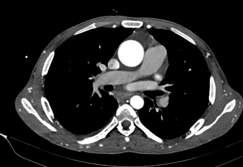 File:Coarctation of aorta with aortic valve stenosis (Radiopaedia 70463-80574 A 86).jpg