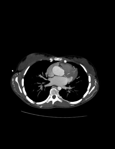 File:Coarctation of the aorta (Radiopaedia 27458-27657 D 14).jpg