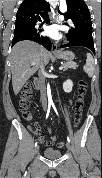 File:Coarctation of the aorta (Radiopaedia 74632-88521 B 121).jpg