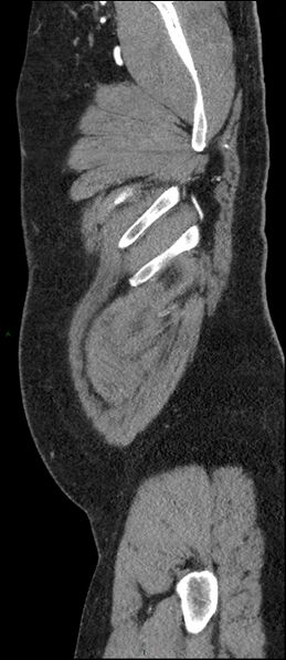 File:Coarctation of the aorta (Radiopaedia 74632-88521 C 10).jpg