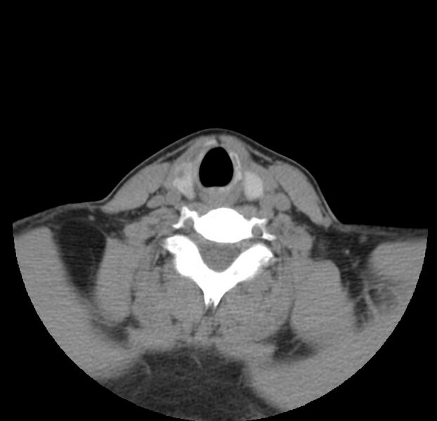 File:Colloid cyst of thyroid (Radiopaedia 22897-22923 Axial non-contrast 38).jpg