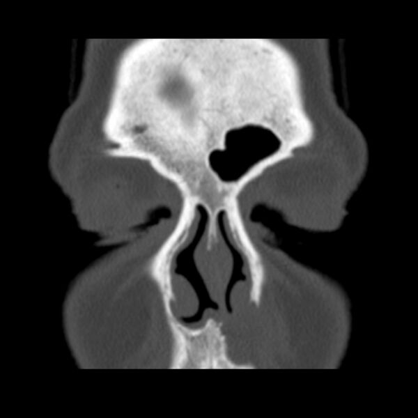 File:Nasolabial cyst (Radiopaedia 33987-35205 Coronal bone window 23).jpg