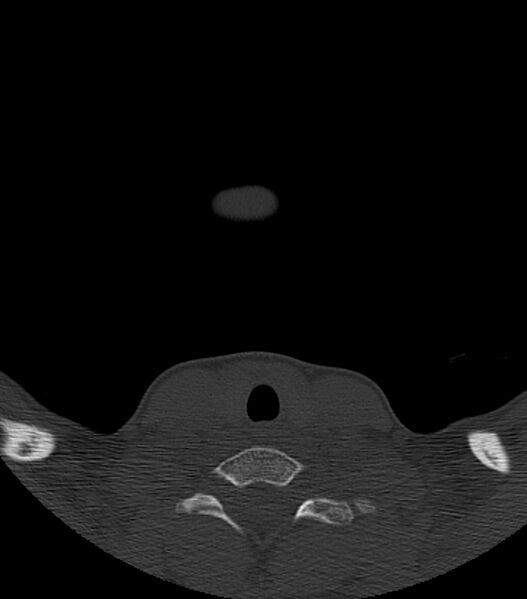 File:Nasoorbitoethmoid fracture (Radiopaedia 90044-107205 Axial bone window 2).jpg