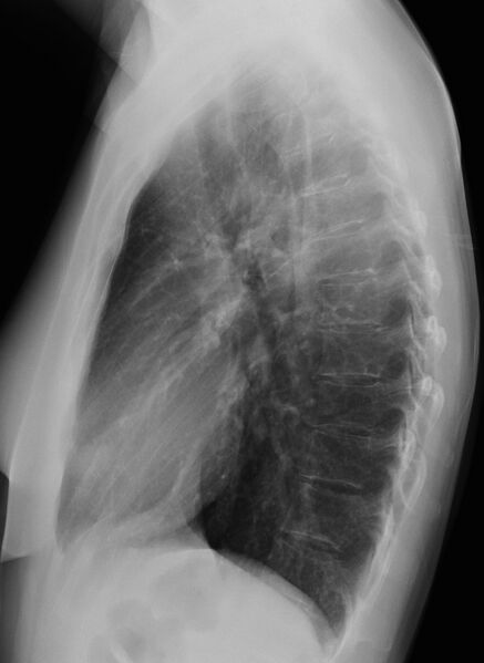 File:Necrobiotic pulmonary nodules - Crohn disease (Radiopaedia 20723-20632 Lateral 1).jpg