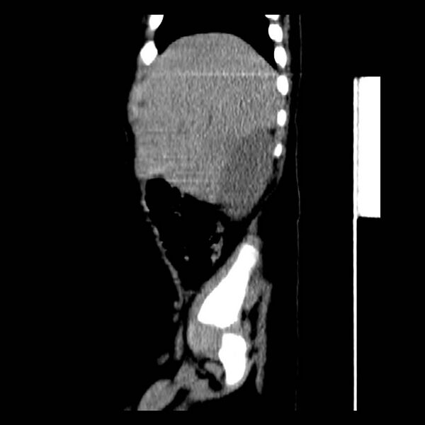 File:Neuroblastoma with skull metastases (Radiopaedia 30326-30960 B 8).jpg