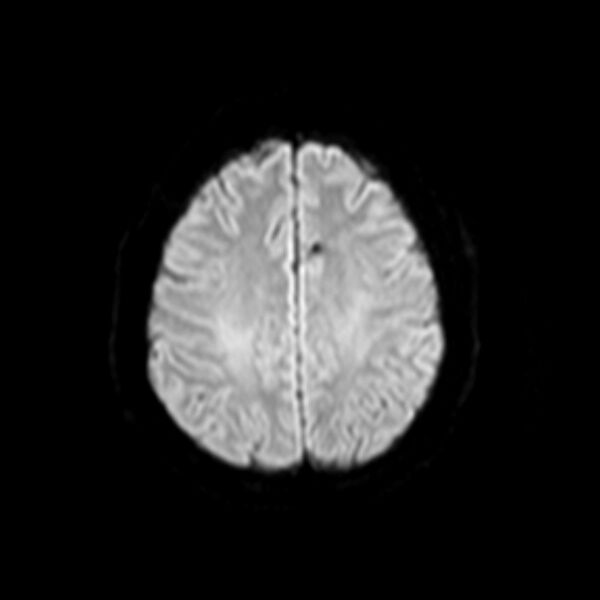 File:Neurofibromatosis type 2 (Radiopaedia 67470-76871 Axial DWI 15).jpg