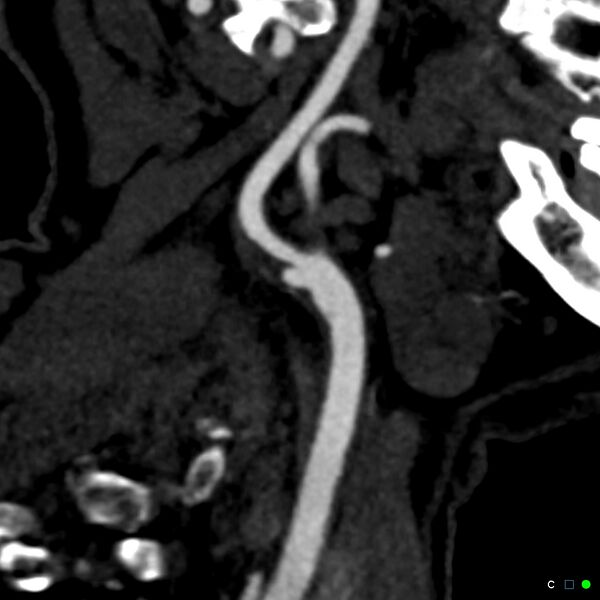 File:Non-occlusive intraluminal internal carotid artery thrombus (Radiopaedia 37751-39658 C 20).jpg