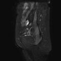 Non-puerperal uterine inversion (Radiopaedia 78343-90983 Sagittal T2 fat sat 24).jpg