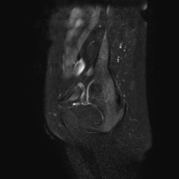 File:Non-puerperal uterine inversion (Radiopaedia 78343-90983 Sagittal T2 fat sat 24).jpg