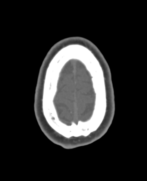 File:Normal CTA head (Radiopaedia 40801-43464 A 13).png