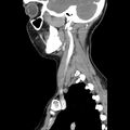 Normal CT of the neck (Radiopaedia 14575-14500 Sagittal C+ 39).jpg