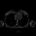 Normal MRI abdomen in pregnancy (Radiopaedia 88001-104541 D 3).jpg