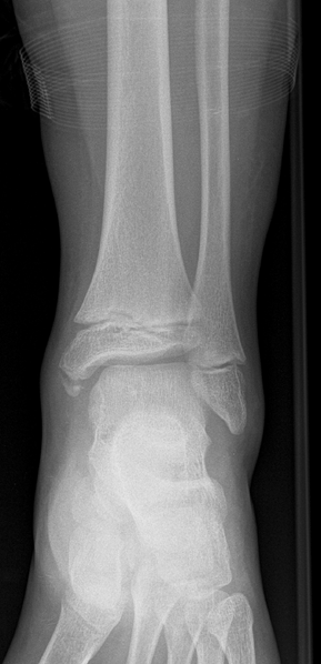 File:Normal ankle x-ray - 11-year-old (Radiopaedia 53474-59477 AP 1).png
