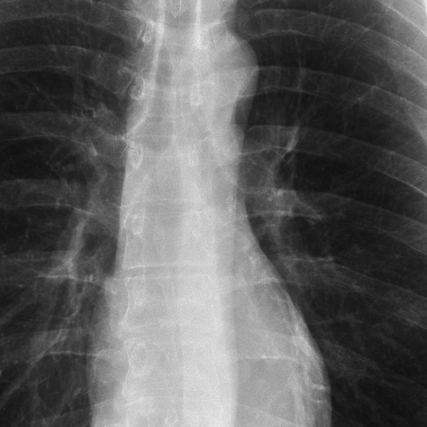 File:Normal chest x-ray (Radiopaedia 8304-9147 magnified 1).png