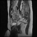 Normal female pelvis MRI (retroverted uterus) (Radiopaedia 61832-69933 Sagittal T2 9).jpg