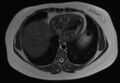 Normal liver MRI with Gadolinium (Radiopaedia 58913-66163 Axial T2 30).jpg