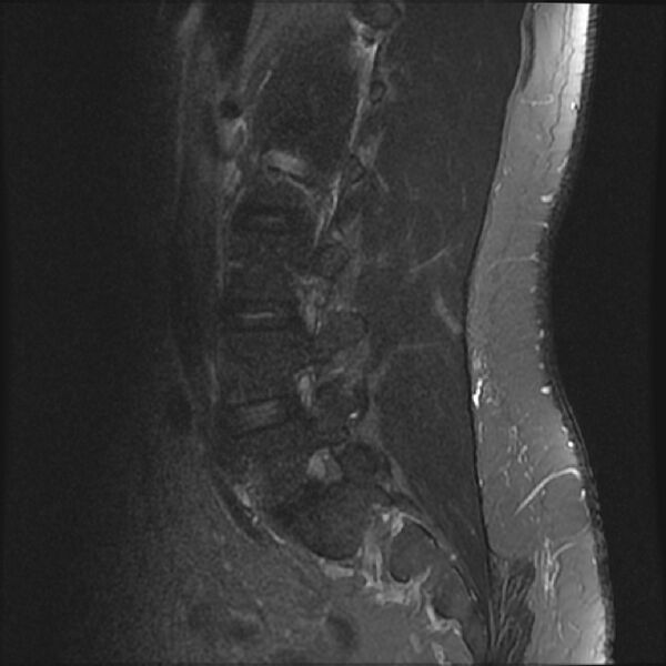 File:Normal lumbar spine MRI (Radiopaedia 43051-46311 Sagittal STIR 16).jpg