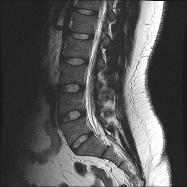 File:Normal lumbar spine MRI (Radiopaedia 43051-46311 Sagittal T2 12).jpg
