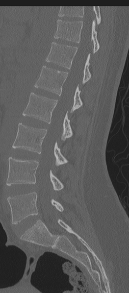 File:Normal lumbosacral CT (Radiopaedia 37923-39867 Sagittal bone window 45).png