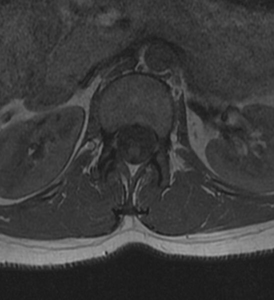 File:Normal thoracic spine MRI (Radiopaedia 41033-43781 Axial T1 34).jpg