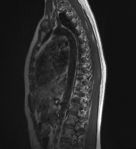 File:Normal thoracic spine MRI (Radiopaedia 41033-43781 Sagittal T1 11).jpg