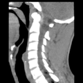 Normal trauma cervical spine (Radiopaedia 41017-43760 B 13).png