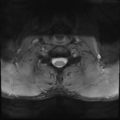 Normal trauma cervical spine (Radiopaedia 41017-43762 Axial T2 22).png