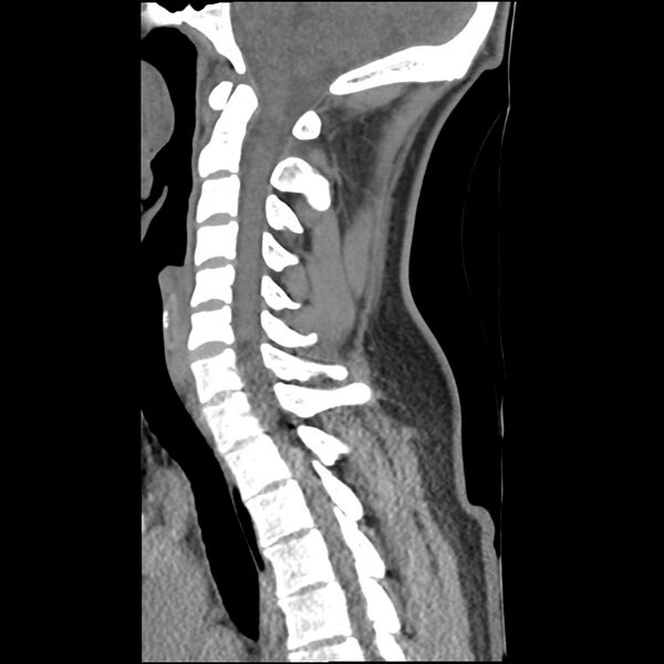 File:Normal trauma spine imaging (Radiopaedia 31753-32686 A 20).jpg