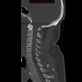 Occipital condyle fracture (Radiopaedia 18366-18208 Sagittal bone window 20).jpg
