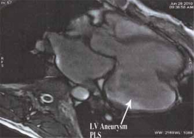 MRI showing the posterobasal left ventricular aneurysm