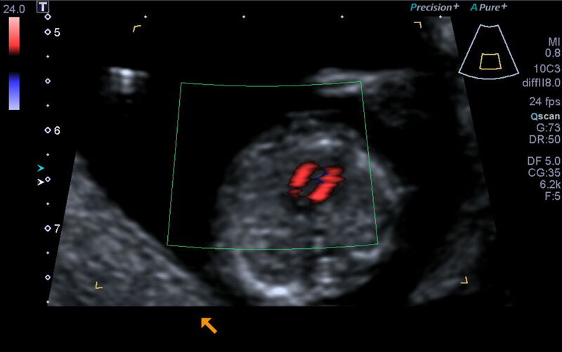 File:1st trimester nuchal-morphology ultrasound (Radiopaedia 44706-48477 Heart views cine with colour 93).jpg