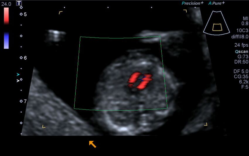 1st trimester nuchal-morphology ultrasound (Radiopaedia 44706-48477 Heart views cine with colour 93).jpg