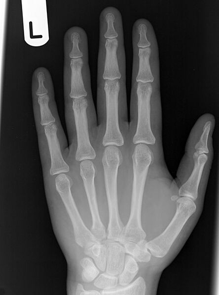 File:4th metacarpal fracture (Radiopaedia 7314-8223 Frontal 1).jpg