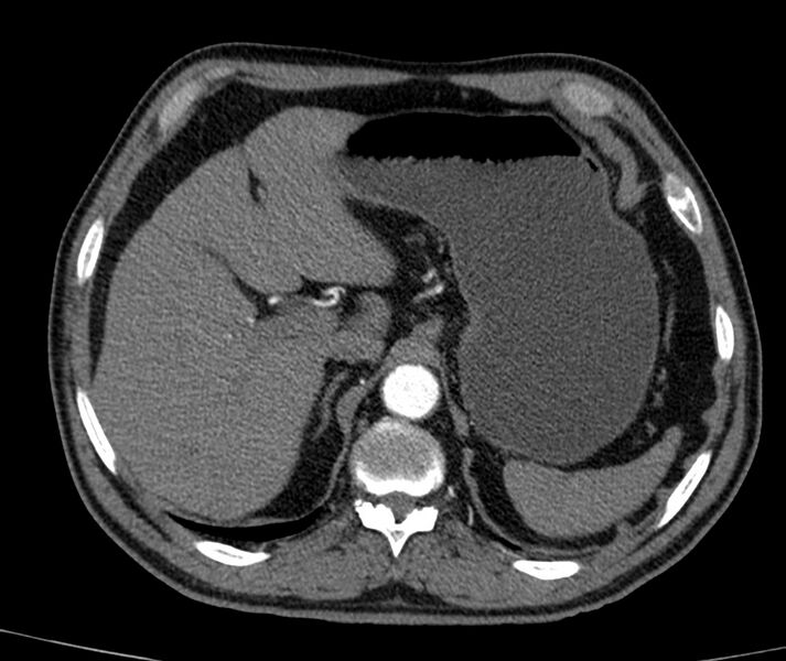 File:Abdominal aortic aneurysm (Radiopaedia 22421-22458 C+ arterial phase 6).jpg