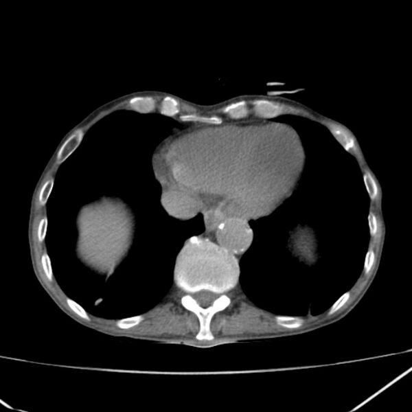 File:Abdominal aortic aneurysm (Radiopaedia 23703-23856 Axial non-contrast 3).jpg