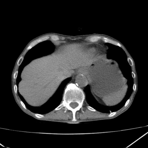 File:Abdominal aortic aneurysm (Radiopaedia 23703-23856 Axial non-contrast 7).jpg