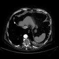 Abdominal aortic aneurysm (Radiopaedia 25855-26001 Axial C+ arterial phase 20).jpg