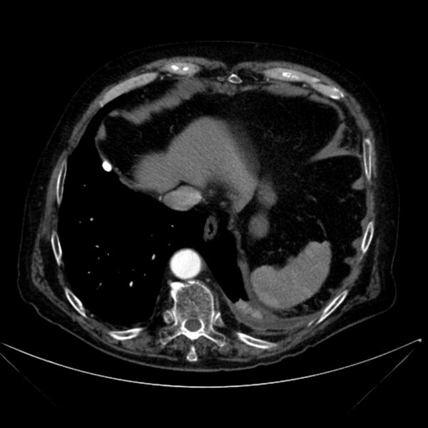 File:Abdominal aortic aneurysm (Radiopaedia 25855-26001 Axial C+ arterial phase 20).jpg