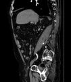 Abdominal aortic aneurysm (Radiopaedia 25855-26001 Sagittal C+ arterial phase 7).jpg