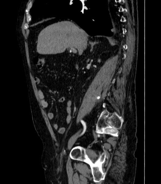 File:Abdominal aortic aneurysm (Radiopaedia 25855-26001 Sagittal C+ arterial phase 7).jpg