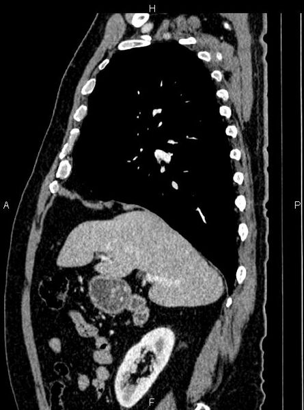 File:Abdominal aortic aneurysm (Radiopaedia 83094-97462 Sagittal renal cortical phase 43).jpg