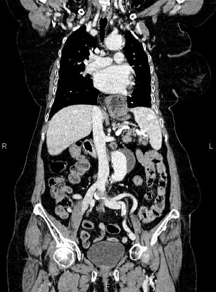 File:Abdominal aortic aneurysm (Radiopaedia 85063-100606 Coronal C+ arterial phase 27).jpg