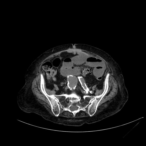 File:Abdominal aortic aneurysm - impending rupture (Radiopaedia 19233-19246 Axial non-contrast 93).jpg