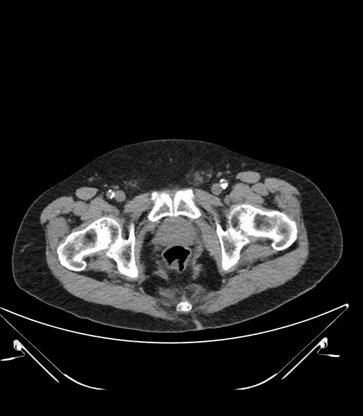 File:Abdominal aortic aneurysm with thrombus fissuration (Radiopaedia 46218-50618 Axial non-contrast 58).jpg