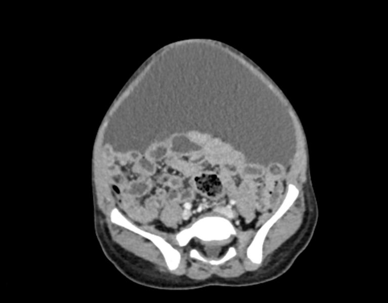 File:Abdominal premesenteric cystic lymphangioma (Radiopaedia 82995-97350 Axial C+ portal venous phase 47).jpg