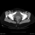 Abdominal wall endometriosis (Radiopaedia 25723-25885 Axial C+ portal venous phase 36).jpg